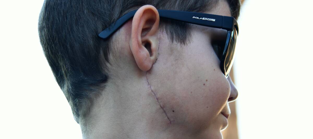 Aftermath: The large scar on Caleb's face following surgery that may allow him to smile again. Photo: Matt Attard